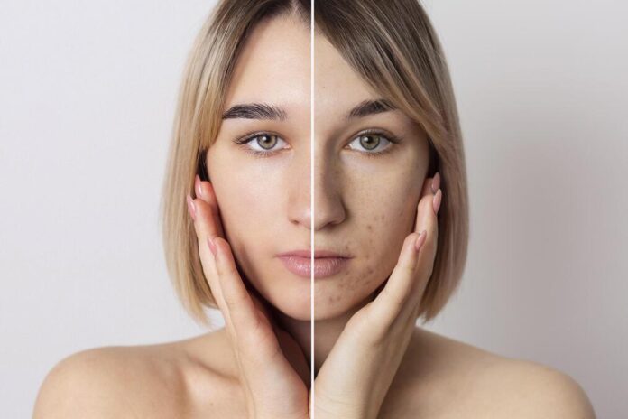 A importância do melasma para a pele