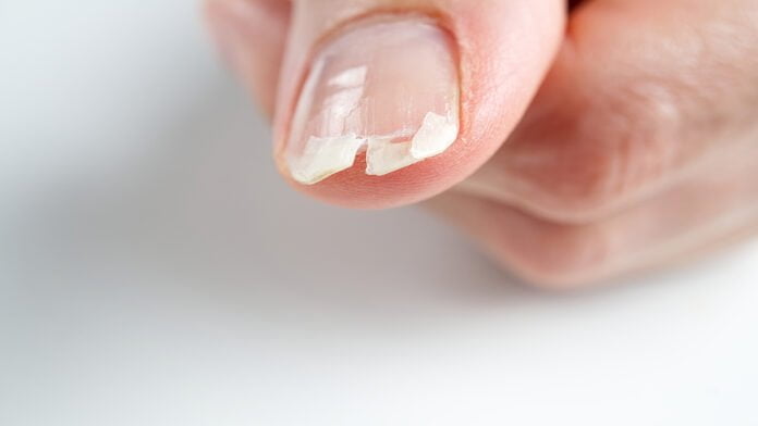 As unhas podem ser um sinal de doença renal?