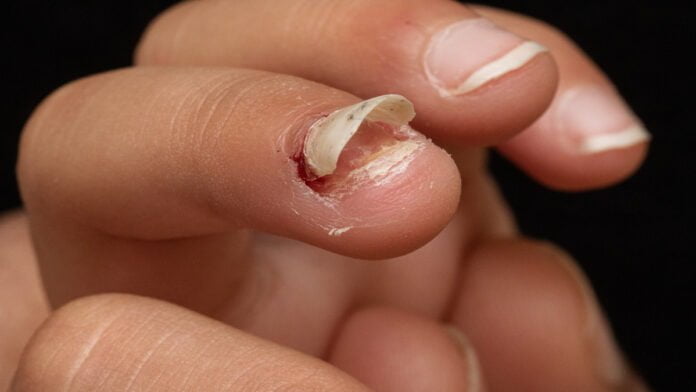 Você sabia que onicomicose é uma doença que afeta a estética das unhas?