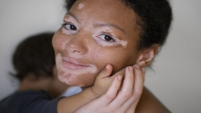 Impigem na pele: condições, causas e tratamento