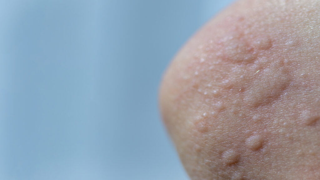 Dermatite como cuidar da pele? Saiba mais! 